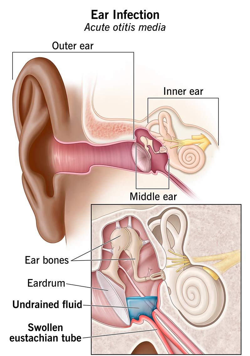 STOP using swimmers ear drops IF you have a hole in your ear drum or have  ear tubes. Comment below if you've learned this lesson the hard way 🫨🙉  #swimmersear #earpain #eartubeorecaution #holeineardrum ..., image size:798x1134